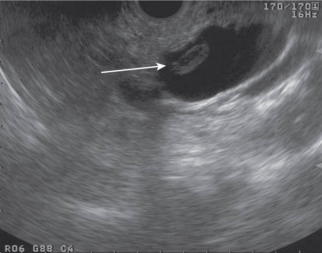 FIGURE 22.6, Mucinous cystic lesion in the head of the pancreas with mural nodule (arrow).