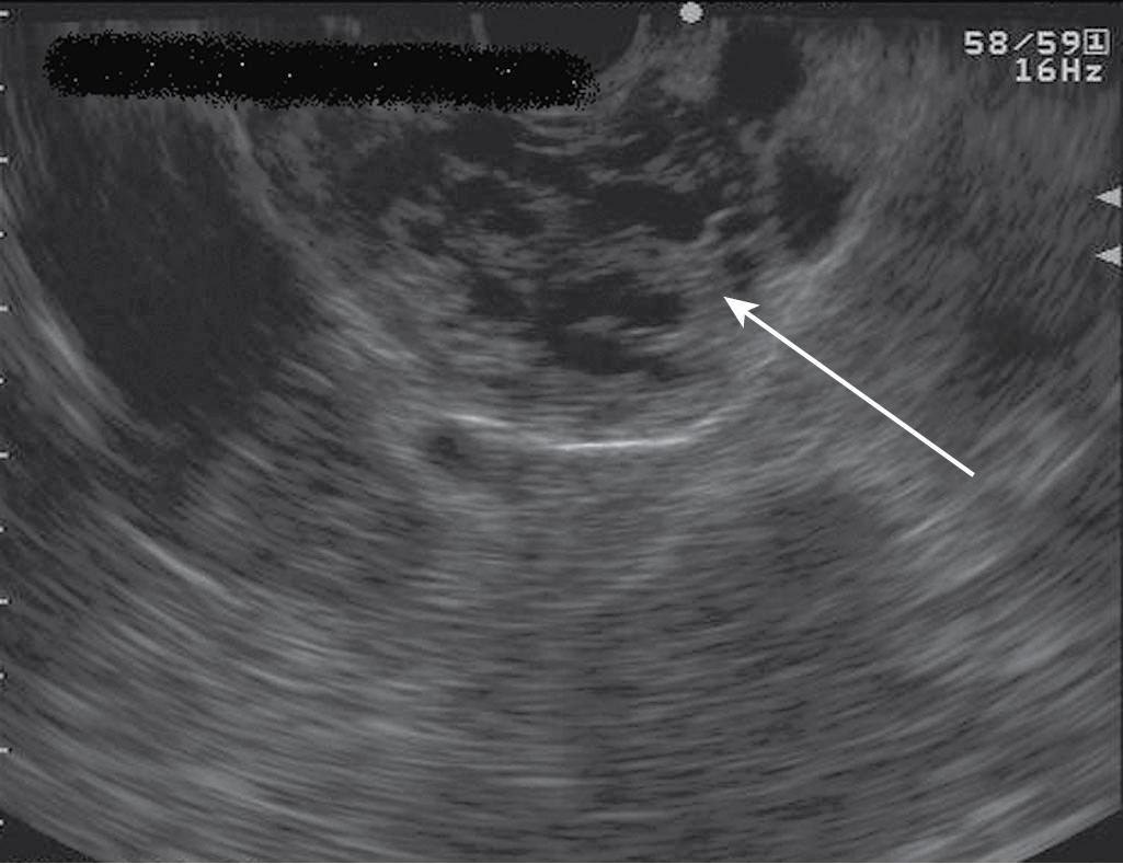 FIGURE 22.8, Typical microcystic appearance of a serous cystadenoma in the head of the pancreas (arrow).