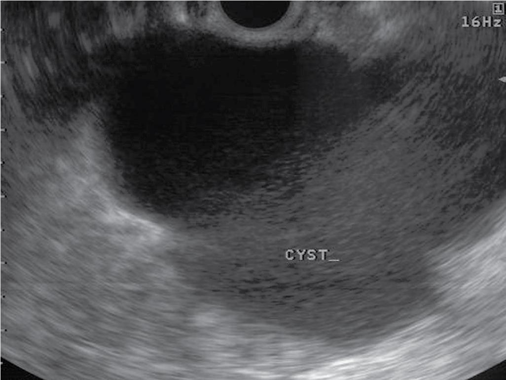 FIGURE 22.9, Bright appearance of fine-needle aspiration of a solid mass in the head of the pancreas.