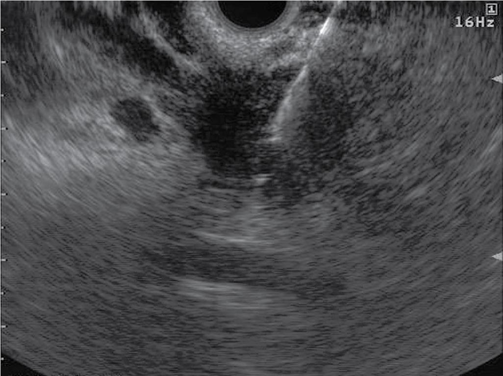 FIGURE 22.10, Fine-needle aspiration of cyst fluid.