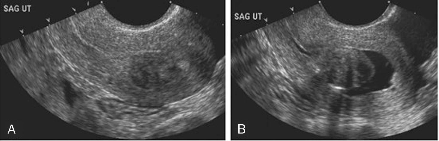 Fig. 10.1, (A) Ultrasound image of a uterine fibroid. (B) Saline-infusion sonogram of the same patient, outlining the submucous fibroid.