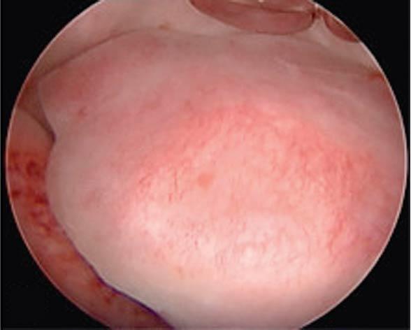 Fig. 10.2, Hysteroscopic view of intrauterine polyp