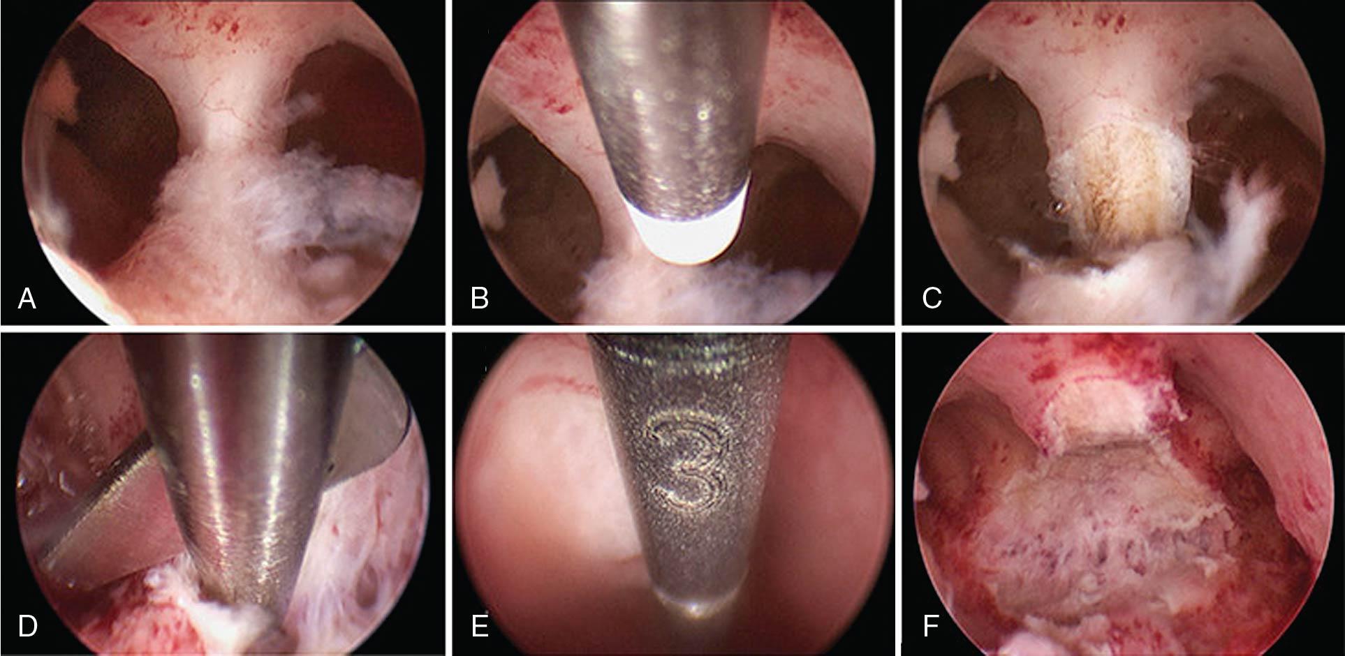 Fig. 10.3, Uterine septum resection. Hysteroscopic metroplasty with miniaturized instruments on a U2a uterus (i.e., a partial septate uterus). The first 2.5 cm of the septum are resected using a 5F bipolar electrode (Karl Storz) (A–C) followed by the last 0.5 cm, which are incised using (D) blunt scissors (D) because care is taken to avoid cutting intraseptal blood vessels. (E) The use of an intrauterine millimetric palpator (KARL STORZ, Germany) introduced via the working channel of the hysteroscope allows checking the actual depth of metroplasty, which may be combined with ultrasound measurements (3 cm of sectioned septum). (F) The final view of the uterine cavity.