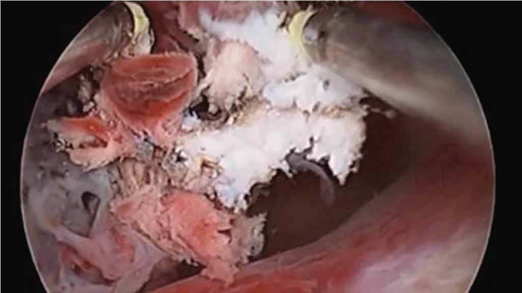 Fig. 10.4, Hysteroscopic removal of retained products of conception.