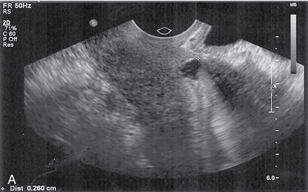 Fig. 10.5, Ultrasound of an isthmocele.