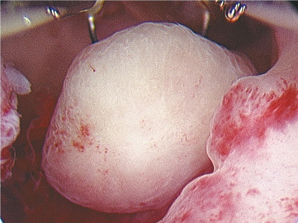 Fig. 10.8, A uterine polyp with the hysteroscopic resection tool behind the polyp.