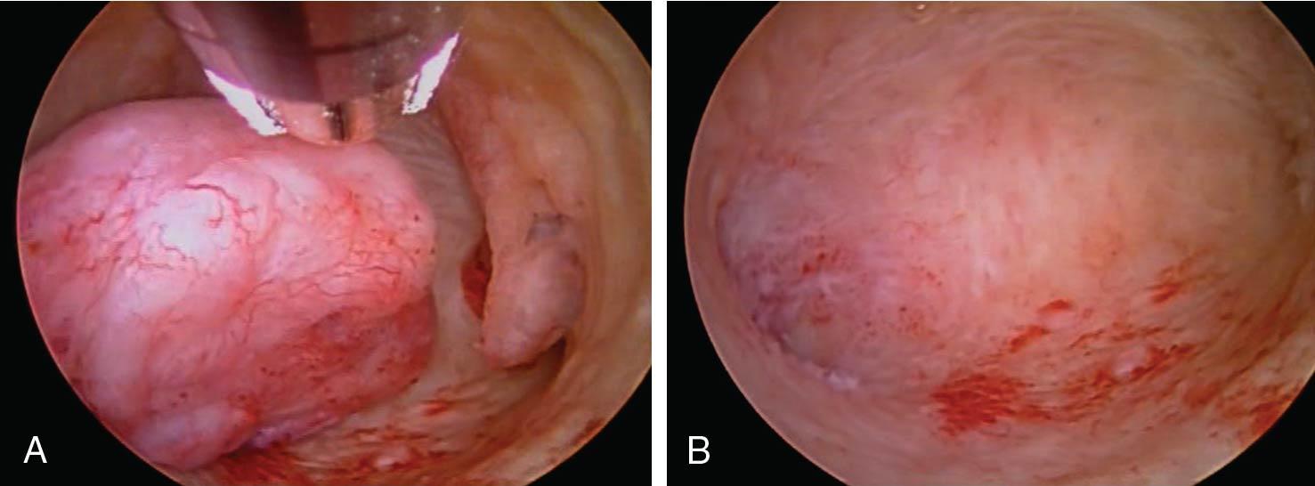 Fig. 10.9, Intrauterine polyp before (A) and after (B) hysteroscopic morcellation.