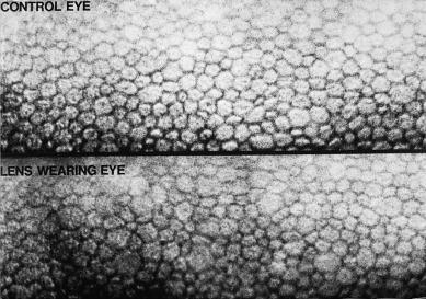 Fig. 32.3, Polymegethous corneal endothelium of the eye of a patient who wore an extended-wear lens in one eye only (bottom frame) for 5 years because of uniocular myopia. The endothelium of the fellow non-lens-wearing control eye is shown in the top frame.