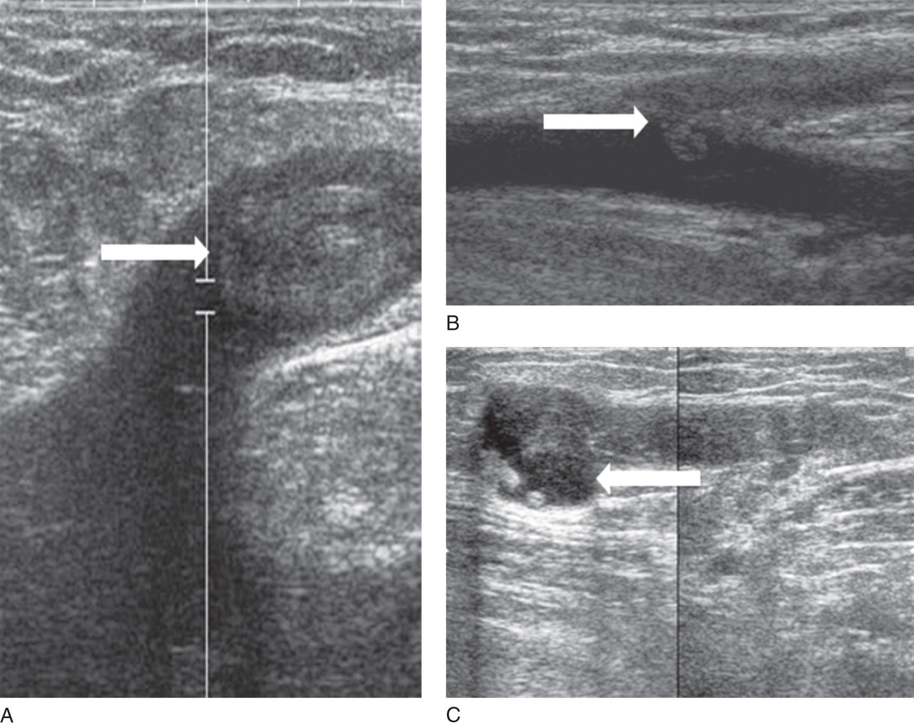 Fig. 16.1, (A) Endothermal heat-induced thrombosis (EHIT) 1: duplex ultrasound demonstrating thrombus that is extending up to and including the respective deep vein junction. Arrow points to thrombus that remains peripheral to the deep vein junction. (B) EHIT 2: thrombus that propagates into the respective deep vein but comprises less than 50% of the deep vein lumen. Arrow points to the thrombus protruding into the common femoral vein. (C) EHIT 3: thrombus that propagates into the respective deep vein, but comprises greater than 50% of the deep vein lumen. Arrow points to the thrombus that is laminating a portion of the wall of the common femoral vein.