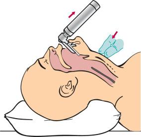 F igure 63-1-2, Sellick maneuver. Either the practitioner or assistant uses the thumb and index and middle fingers pinched into a double “V” or tripod. Posterior pressure is then applied to the cricoid to avoid aspiration and bring the larynx into view. Note the upward and forward direction of forces applied in a nonfulcrum manner by the laryngoscope.