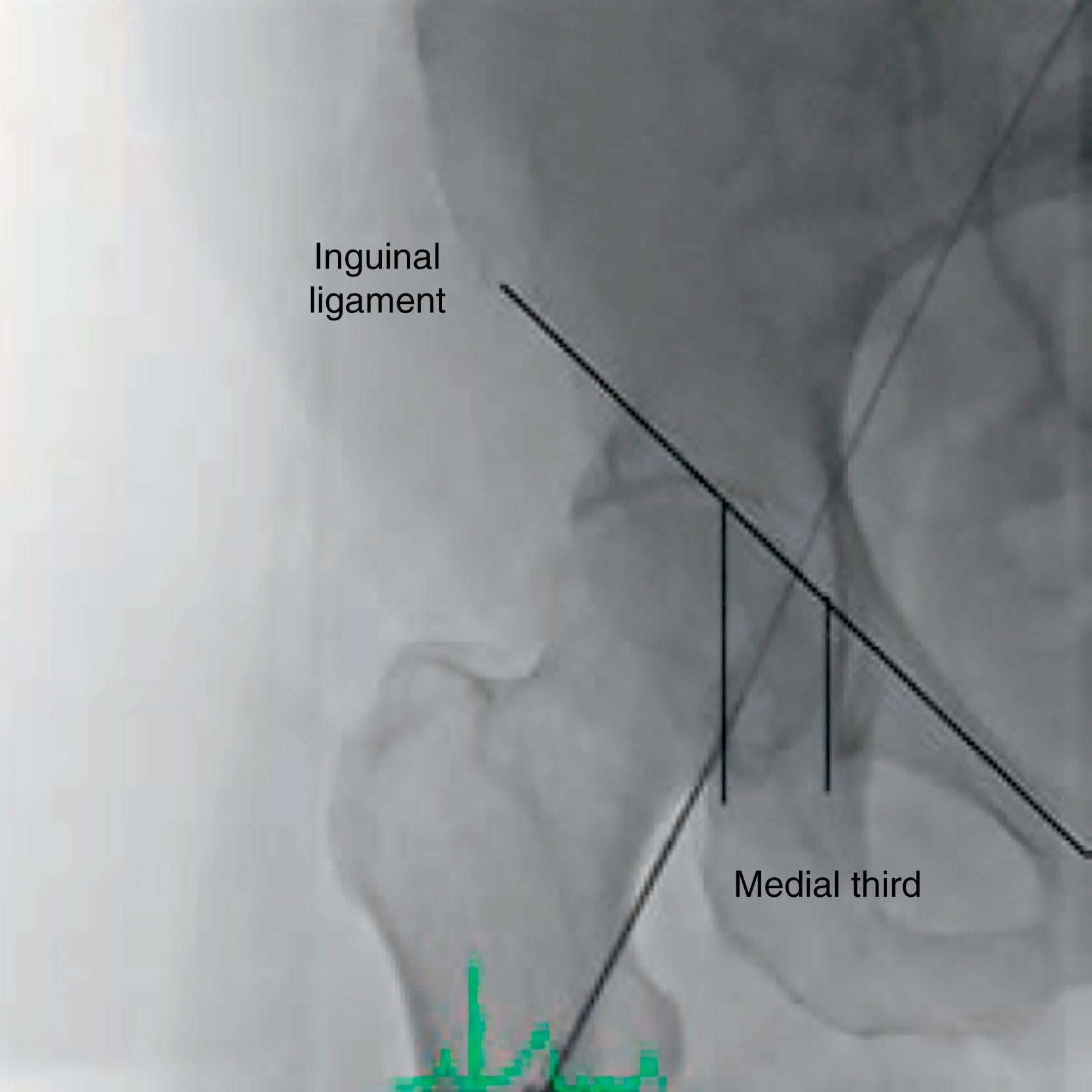 Figure 62.1, Anatomy of the femoral artery with the inguinal ligament and femoral head delineated. The common femoral artery lies over the medial one-third of the femoral head. A wire is located within the femoral artery in this X-ray image.