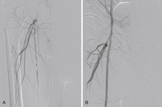 FIGURE 1, Diffuse lesion of the superficial femoral artery. A, Arteriogram shows tandem superficial femoral artery lesions. B, After treatment with a covered stent, the artery is widely patent.