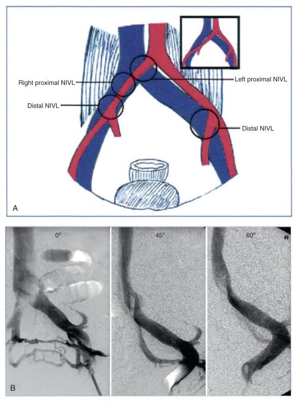 FIG 52.1, (A) The pathologic anatomy of a nonthrombotic iliac vein lesion (NIVL) . The classic left-sided proximal lesion is related to abrupt crossing of the left iliac vein by the right iliac artery. Coursing lazily across the vein, the right iliac artery may be related to the proximal or distal NIVL or both. The left hypogastric artery crossing may be related to the left distal NIVL. The hypogastric veins have been omitted to reduce clutter. (B) The proximal NIVL appears as a translucent area on venography in frontal projection. The tight stenosis is clearly visible in 60-degree projection. Collaterals seen in this case are present in only one-third of cases.