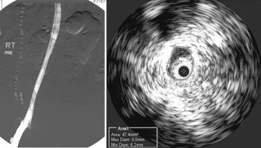 FIG 52.2, Diffuse postthrombotic stenosis may not be recognized on venography (left) . It is clearly visible on intravascular ultrasound (IVUS) examination (right). Cross-sectional area by IVUS planimetry measured 47 mm 2 (normal external iliac vein luminal area ≥150 mm 2 ).