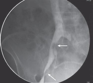 FIG 52.3, The postthrombotic iliac vein lesion shown here is likely a result of deep venous thrombosis related to a motor vehicle crash when the patient was in her twenties. There was onset of leg swelling when the 80-year-old patient suffered a fibular fracture after a fall. Stent placement resolved the swelling.