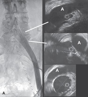 FIG 52.4, (A) The venogram on the left appears grossly normal. Note the absence of collaterals. However, intravascular ultrasound (IVUS) examinations at indicated locations show significant stenosis. The crossing artery is marked A in the IVUS images. The IVUS image at the bottom (right) shows a normal lumen after stent placement. (B) A stent stack extending from just beyond the iliocaval confluence to the common femoral vein.