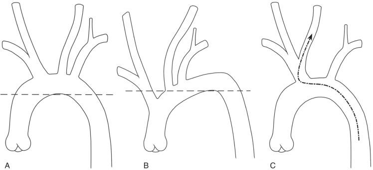 FIG 21.1, Evaluation of the Aortic Arch.