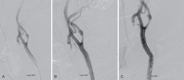 FIG 21.3, Carotid Sheath Placement.