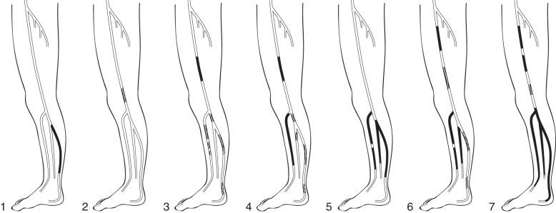 FIG 31.1, Graziani classification scheme for multilevel infrainguinal disease.