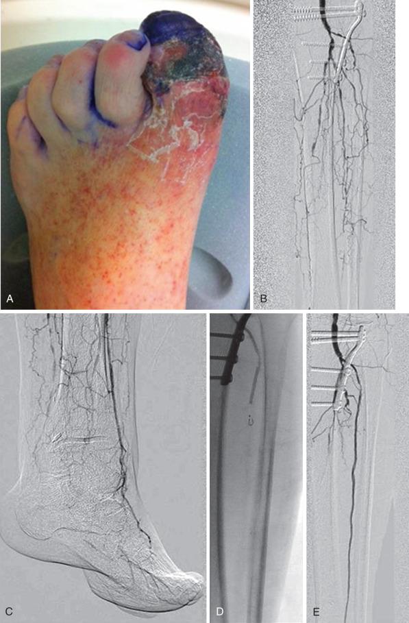 FIG 31.2, A 77-year-old high-risk patient with diabetes and great toe gangrene. (A) Critical limb ischemia with ankle-brachial index (ABI) of 0.39. (B) Three-vessel long-segment (>25 cm) tibial artery occlusions, with (C) distal anterior tibial artery reconstitution. (D) Subintimal angioplasty of long-segment occlusion. (E) Anterior tibial artery after long-segment subintimal angioplasty with ABI improved to 0.81. Toe amputation healed and the vessel remains patent 6 months after intervention.