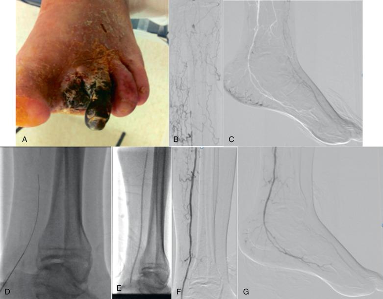 FIG 31.3, (A) A 69-year-old frail patient with diabetes, renal failure, and nonhealing toe amputation site. The patient had nonpalpable pedal pulses and a toe pressure of 12 mm Hg. (B) Diagnostic angiogram showed occluded popliteal and tibioperoneal arteries. (C) Distal reconstitution of the posterior tibial artery by means of collaterals at the ankle level. (D) Retrograde access of the ankle-level posterior tibial artery and further crossing of the long-segment occlusion with a V-18 control wire supported by a 0.018-inch CXI angled microcatheter. (E) Angioplasty with a 3.5 mm × 220 mm low-profile balloon. (F) Technical success and linear flow down to the foot after multilevel intervention. (G) Widely patent and perfused pedal plantar loop after retrograde recanalization and treatment of the posterior tibial artery.