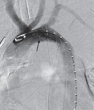 FIG 37.2, Angiogram showing “bird beaking” of the proximal endograft. The arrow shows proximal TEVAR “bird beaking” along the lesser curvature of the aortic arch.