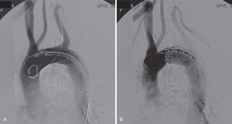FIG 37.3, Angiogram—predeployment (A) and postdeployment (B). Note complete coverage of the left subclavian artery.