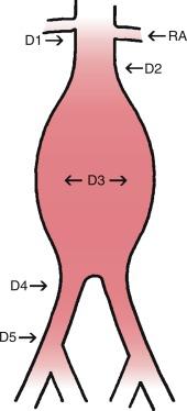 Fig. 38.1, Diagram Representing an Abdominal Aortic Aneurysm.