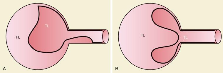 Fig. 34.3, (A) Static obstruction. Dissection has extended into a branch vessel. (B) Dynamic obstruction. Membrane is lying across and obstructing origin of branch vessel. FL, False lumen; TL, true lumen.