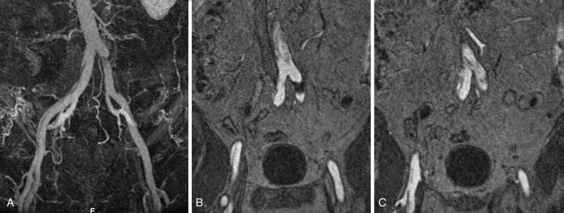 Fig. 34.4, Magnetic Resonance Imaging of Static Branch Vessel Involvement of Iliac Arteries.