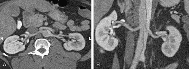 Fig. 34.5, Computed Tomography (CT) Images of True and False Lumen Relationships to Renal Arteries.