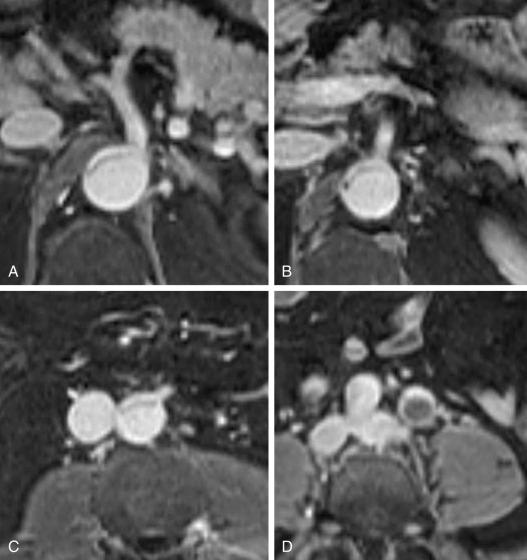 Fig. 34.6, Magnetic resonance imaging (MRI) demonstrates dynamic branch vessel involvement, with aortic true lumen collapse and accompanying static no-reentry obstruction of left common iliac artery (CIA). (A – C) Axial MRI shows wafer-thin crescent-shaped true lumen collapsed against anterior aortic wall at level of visceral arteries. Aortic septum prolapses like a curtain across the origins of branches originating from true lumen, with resultant malperfusion and multiorgan ischemia. (D) At the level just below aortic bifurcation, there is marked asymmetry in appearance of CIAs. Lumen of left CIA has a flow void (black circle) due to static involvement without reentry that coexists with the dynamic process observed more proximally.