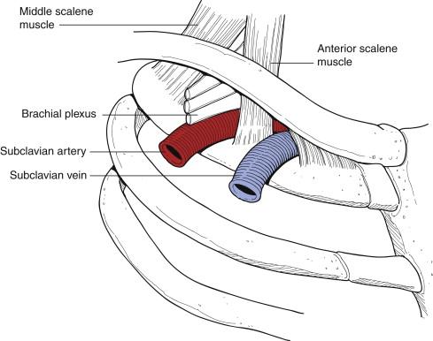 Figure 17-1, Anatomy of the venous (anterior) portion of the thoracic outlet. The vein passes through the junction of the clavicle and first rib anteriorly and is potentially compressed by the costoclavicular ligament anteriorly and the subclavius muscle and tendon superiorly. The venous thoracic outlet is anterior to the anterior scalene muscle; thus neurogenic and venous thoracic outlet syndromes are two different entities.