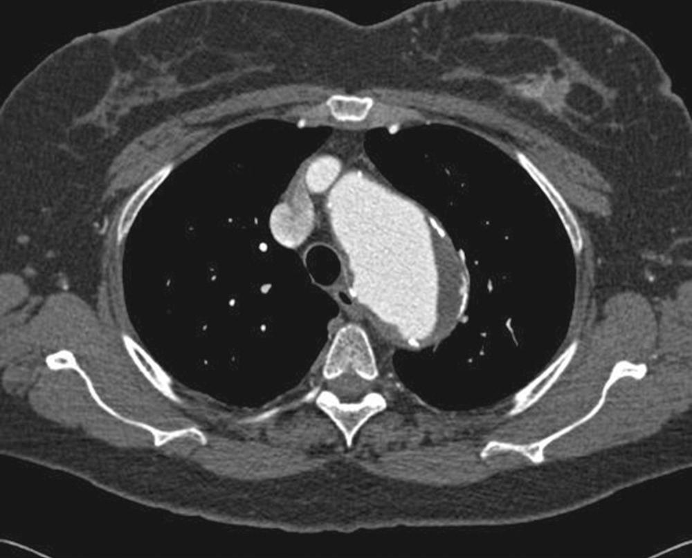 FIGURE 72-5, Computed tomographic angiography of a descending thoracic aortic aneurysm.