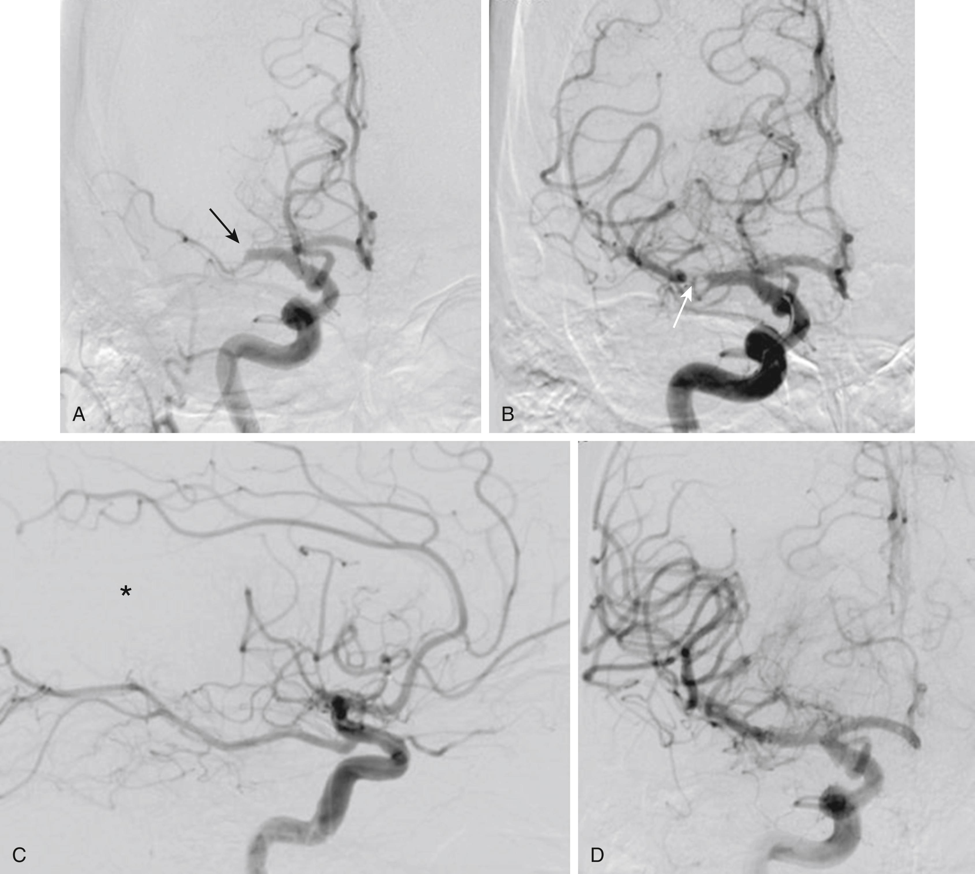 Fig. 67.2, (A) Anteroposterior view of the right common carotid artery injection shows occlusion of the middle cerebral artery M1 segment (black arrow) in this patient with acute right hemispheric syndrome. (B) Anteroposterior view of the right internal carotid artery injection shows reestablishment of antegrade flow upon deployment of the stent retriever. The apparent flow gap seen in the M1 segment (white arrow) is where the clot is being compressed against the vessel wall, allowing for the establishment of antegrade flow. (C) Lateral view of the right internal carotid artery injection following a single retrieval shows reopening of the prefrontal branches of the middle cerebral artery but continued occlusion of the posterior frontal and the parietal branches (asterisk) . (D) Anteroposterior view of the right internal carotid injection following the second retrieval with stent device shows complete recanalization of the middle cerebral artery branches.