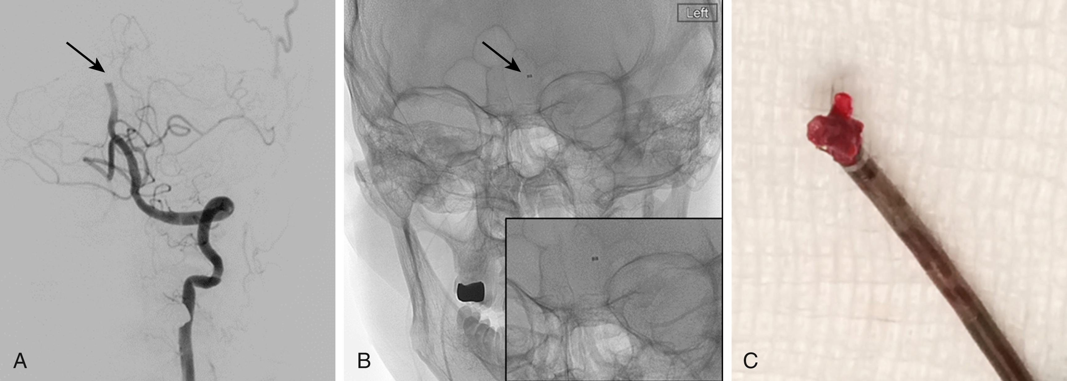 Fig. 67.3, (A) Anteroposterior view of the left vertebral artery injection shows complete occlusion of the distal basilar artery (arrow) in this patient with acute ischemic stroke. (B) Unsubstrated image of the skull shows the tip of the large-bore catheter (arrow) , which has been advanced to the proximal face of the clot in the basilar artery. The figure insert in the right lower corner is a high-magnification view showing the tip of the large-bore catheter in position. Aspiration was applied to the large-bore catheter to engage the clot. Then, while maintaining aspiration to keep the clot engaged, the catheter was retrieved into a guide catheter in the proximal vertebral artery (a direct aspiration first-pass technique [ADAPT] technique). (C) Following retrieval, the clot is seen to be engaged within the tip of the large-bore catheter.