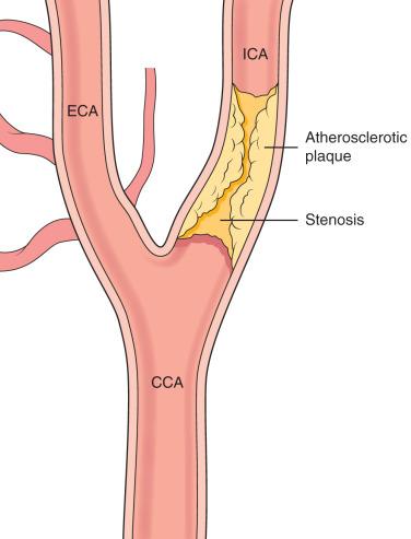 Figure 23.1, (A) Diagrammatic illustration showing the buildup of atherosclerotic plaque in the internal carotid artery (ICA) resulting in stenosis and flow compromise. (B) Reconstructed computed tomographic angiography (CTA) of the neck, showing chronic calcified plaque in the left internal carotid artery (white arrow).