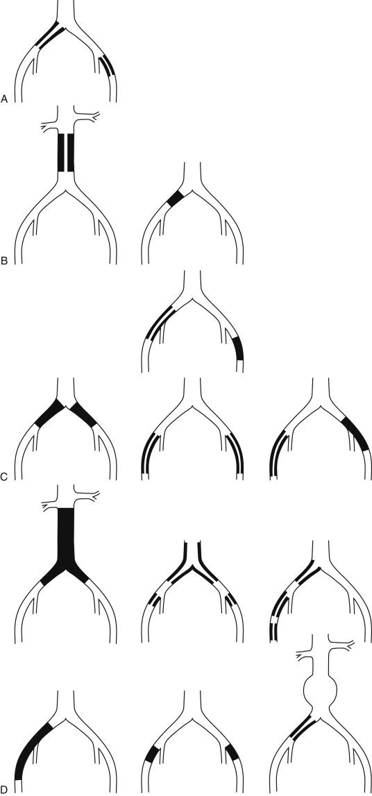 Figure 30-1, TASC II classification of aortoiliac lesions. See Table 30-1 .