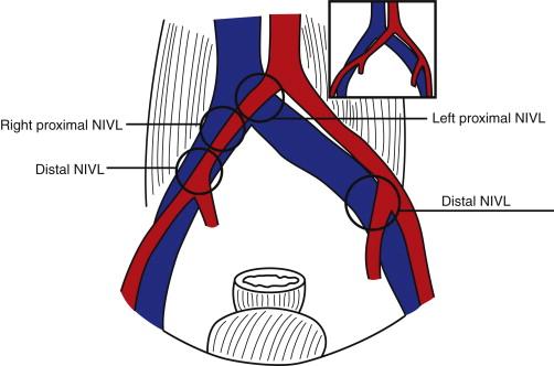 FIGURE 1, Arterial and venous relations in nonthrombotic iliac vein lesions (NIVLs). A common variant is shown in the inset. Right- and left-sided proximal and distal lesion locations are shown.