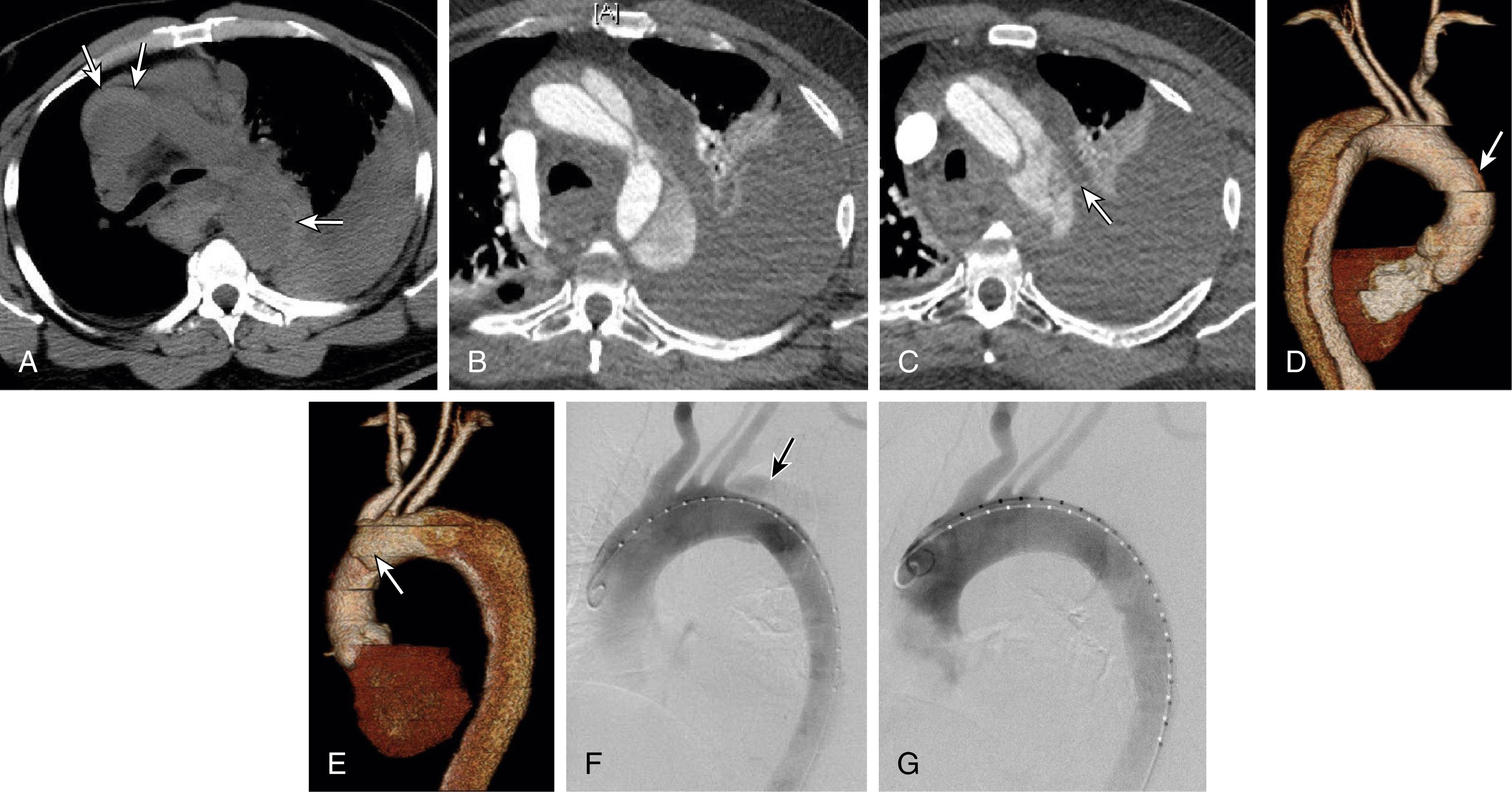 Fig. 24.1, A 69-year-old man with complicated acute type B aortic dissection managed by thoracic endograft placement. (A) Axial CT image at level of carina, without contrast enhancement. Circular rims of high-attenuation tissue density surround both ascending and proximal descending thoracic aorta ( arrows ), strongly suggesting acute aortic intramural hematoma (IMH). (B) Patient presented with chest pain and systolic blood pressure over 200 mmHg. After intravenous contrast is administered, repeated CT imaging shows aortic dissection within aortic arch. (C) CT image at a level slightly higher in arch demonstrates a large fluid density surrounding the arch and a small wisp of contrast ( arrow ) beyond the expected confines of the aorta—findings diagnostic for aortic rupture. (D) 3D surface-rendered CT image of posterior aspect of thoracic aorta demonstrates descending aorta dissection and a small amount of hematoma surrounding ascending aorta ( arrow ), without obvious abnormality affecting posterior arch. (E) Similarly rendered 3D view of anterior side of aortic arch shows obvious involvement of arch, with dissection extending along its anterior surface ( arrow ). (F) Left anterior oblique projection of a thoracic aortogram shows location of primary entry tear just distal to left subclavian artery, with opacification of a limited extent of false lumen ( arrow ). Together the imaging allows a diagnosis of a type IIIa aortic dissection with retrograde proximal extension from a primary entry tear just distal to left subclavian artery origin. False lumen is patent to a limited extent in the arch, but not in ascending aorta, where there is only evidence of IMH. (G) Aortogram after deployment of endovascular stent-graft across primary entry tear, extending from left subclavian artery origin to mid-segment of descending aorta. After TEVAR there is no longer filling of false lumen. Patient was discharged home on third day after procedure.