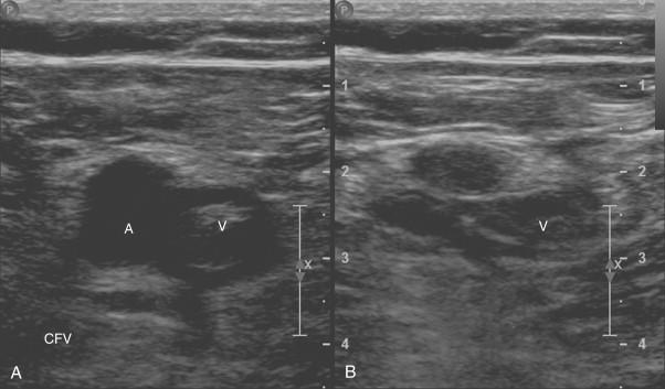 Figure 58-2, Ultrasound confirms thrombosis of the right common femoral vein in a woman with acute onset of right thigh pain. A , Before compression of the femoral vein with the ultrasound probe, an echogenic filling defect is noted within the lumen of the vein. B , Noncompressibility of the femoral vein confirms the diagnosis of DVT. A , Common femoral artery; V , common femoral vein.