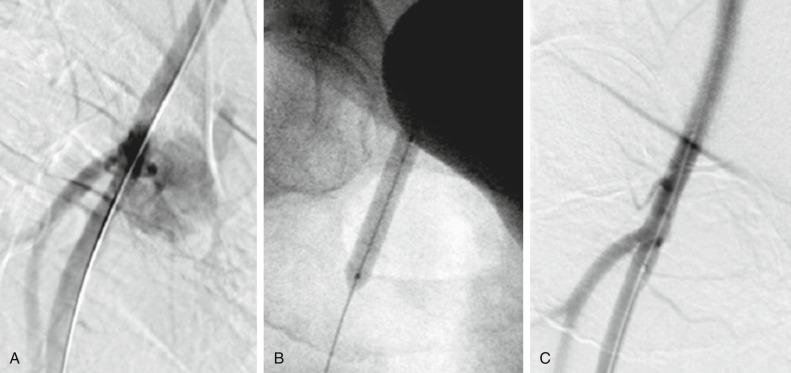 Fig. 20.1, Access site complication with bleeding (A) successfully tamponaded with balloon inflation (B), and final angiogram showing hemostasis (C).