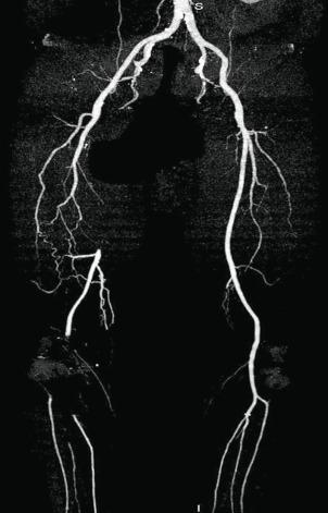 Fig. 20.2, Computed Tomographic Angiogram of Lower-Extremity Vasculature.