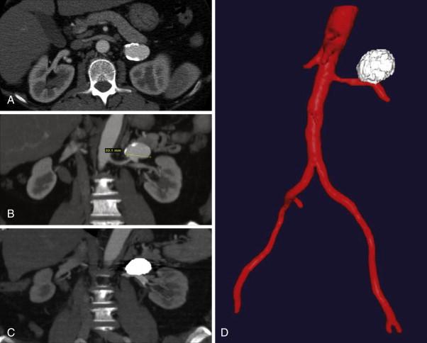 Figure 39-1, A and B, Axial CT images and coronal reconstruction revealing a saccular left renal artery aneurysm. C and D, Coronal and 3D CT imaging after coil embolization and stenting of the renal artery aneurysm.