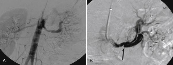 Figure 39-2, A, Aneurysmal dilatation of the left renal artery after arterial dissection. B, The entry tear to the false lumen is revealed by the presence of an intimal defect (arrow).