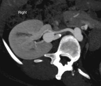 Figure 39-3, CT angiogram demonstrating a renal artery aneurysm at a distal branch point of the main renal artery.