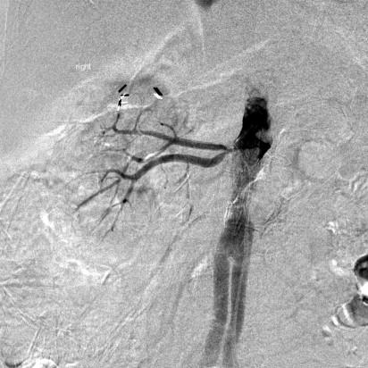 Figure 38-2, Arteriogram demonstrating a short right main renal artery with a high-grade stenosis just proximal to arterial bifurcation, highlighting the potential risk of segmental renal ischemia if a substantial renal branch is covered with a stent or stent graft.