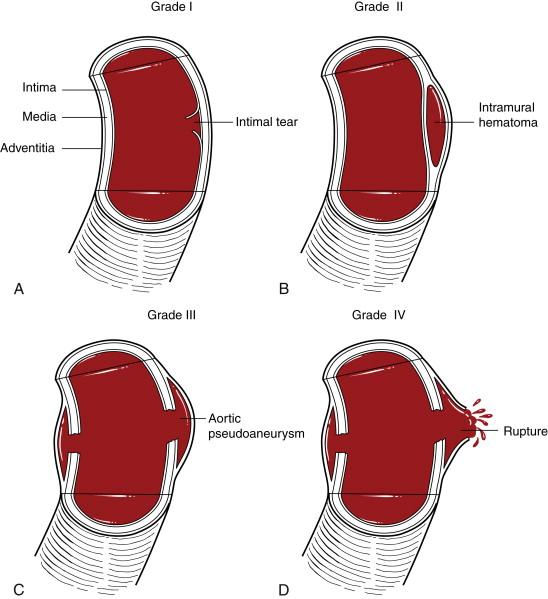 Figure 22-1, Grading scheme of traumatic aortic injury of the thoracic aorta. A, Grade I: Intimal tear, B, Grade II: Intramural hematoma, C, Grade III: Aortic pseudoaneurysm, D, Grade IV: Rupture.