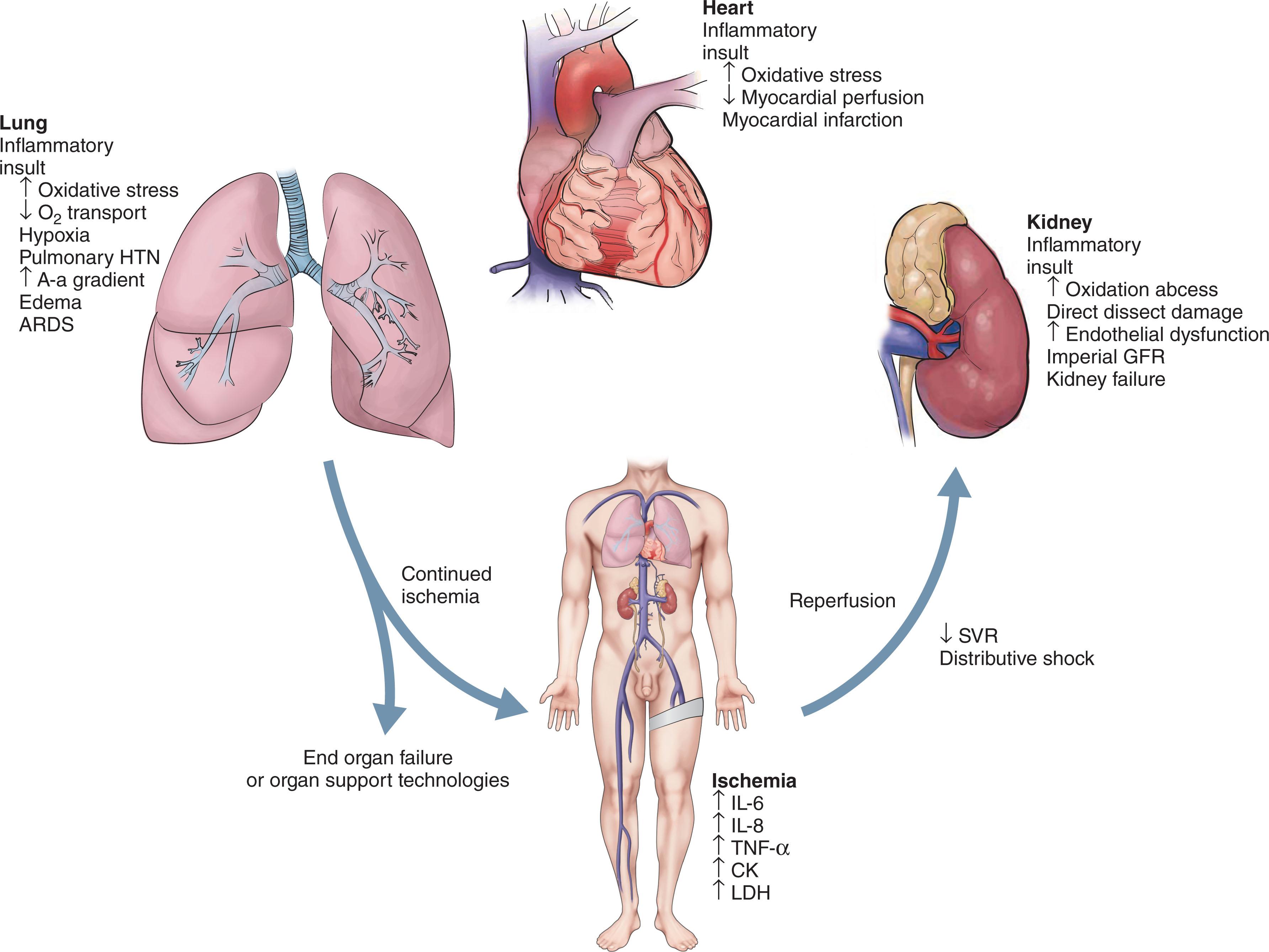 Fig. 14.1, Anatomic schematic representing the cascade of events that occurs during an ischemia reperfusion insult. Ischemia results in cellular dysoxia which leads to cell death and the local release of intracellular enzymes, inflammatory cytokines, and chemokines into the local tissue. Upon reperfusion of the tissue bed, the compilation of the enzymes is released into the systemic circulation resulting in direct and indirect inflammatory injuries to various organs including the kidneys, heart, lungs, liver, and gastrointestinal tract. This ultimately leads to end-organ failure that can occur in isolation or in combination. ARDS , Acute respiratory distress syndrome; CK , creatine kinase; GFR , glomerular filtration rate; HTN , hypertension; IL , interleukin; LDH , lactate dehydrogenase; SVR , systemic vascular resistance; TNF-α , tumor necrosis factor-α.