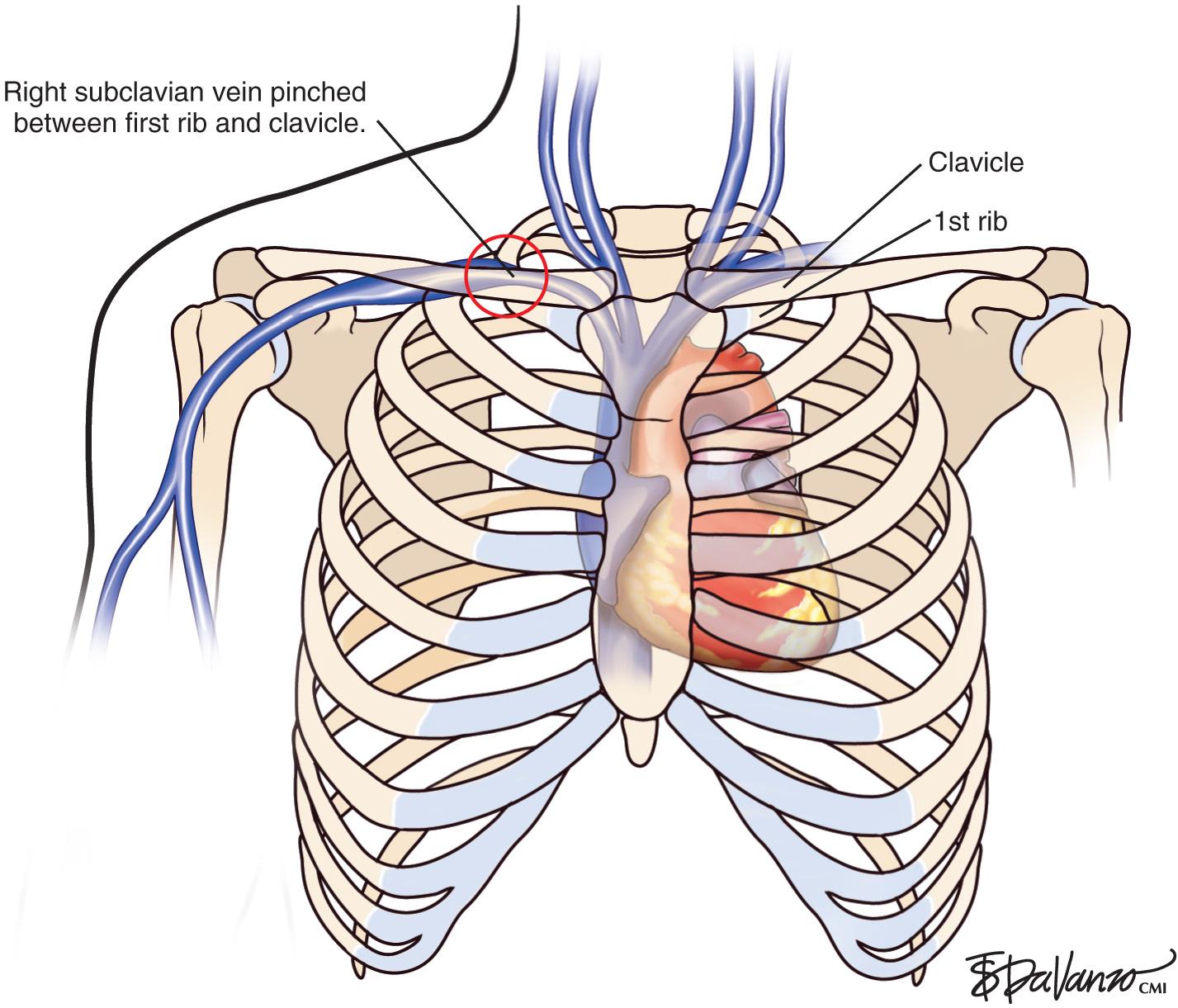 Fig. 24.1, Diagram demonstrating the junction of both brachiocephalic veins into the superior vena cava.